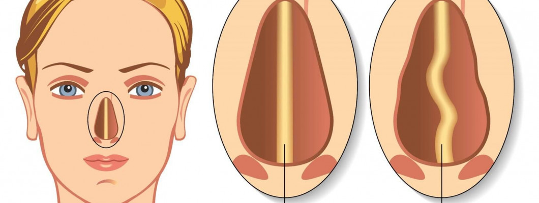 Искривление перегородки носа. Лечение перегородки носа.